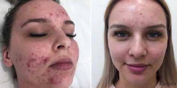 Kleresca® Acne - the revolutionary skin treatment for acne and acne scarring 