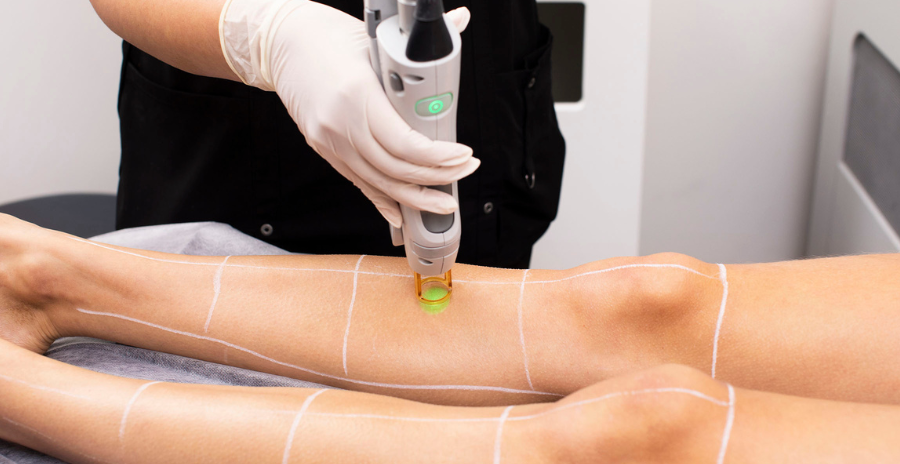 How Does Laser Hair Removal Work?