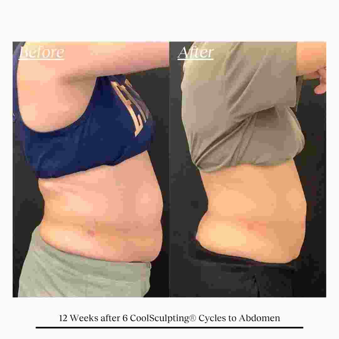 COOLSCULPTING  (7).jpg