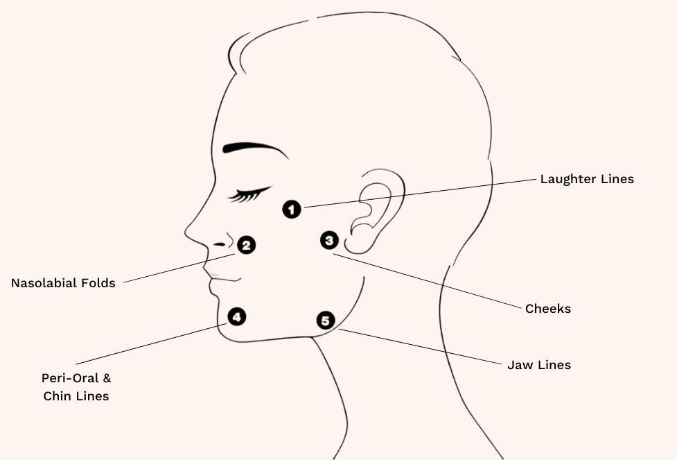 profhilo-areas-we-treat-1.png