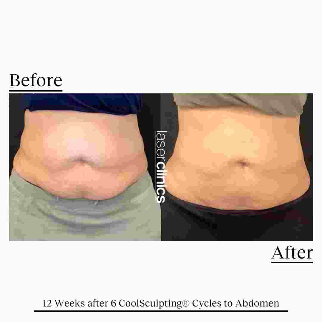 COOLSCULPTING  (5).jpg