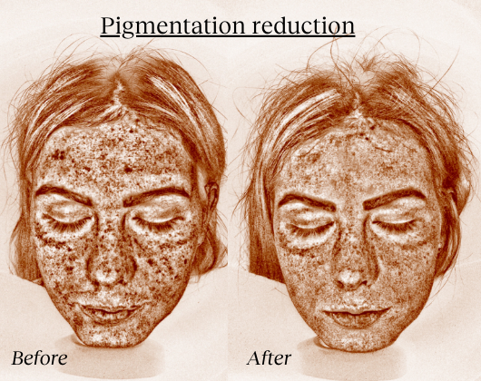 PRP Pigmentation B+A 2.png
