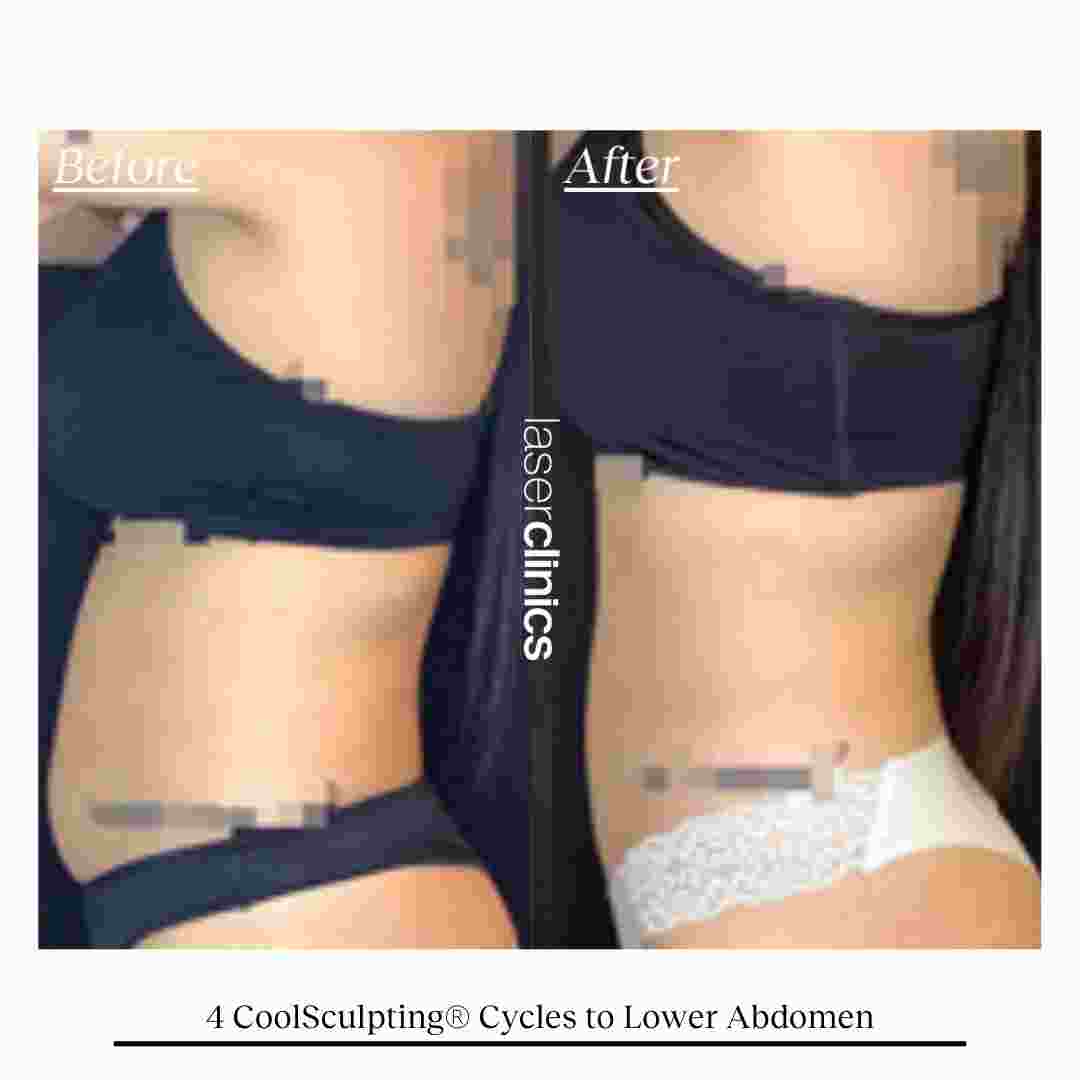 COOLSCULPTING  (11).jpg