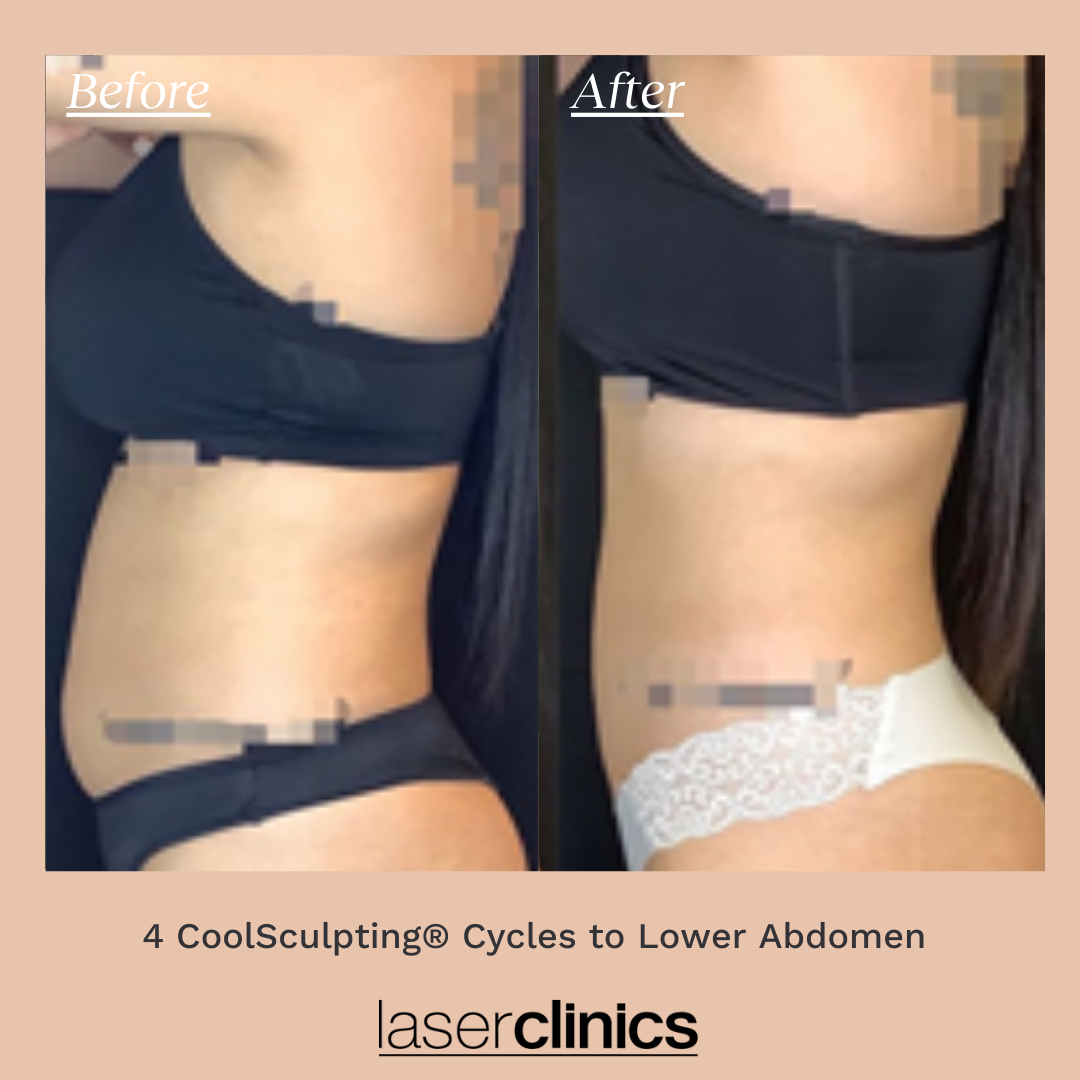 CoolSculpting B&A.png