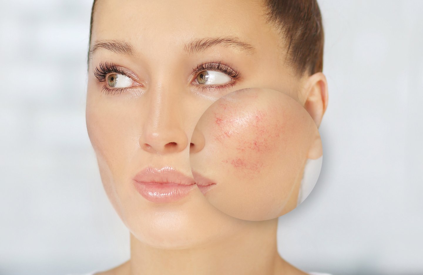 Rosacea@2x (1).jpg
