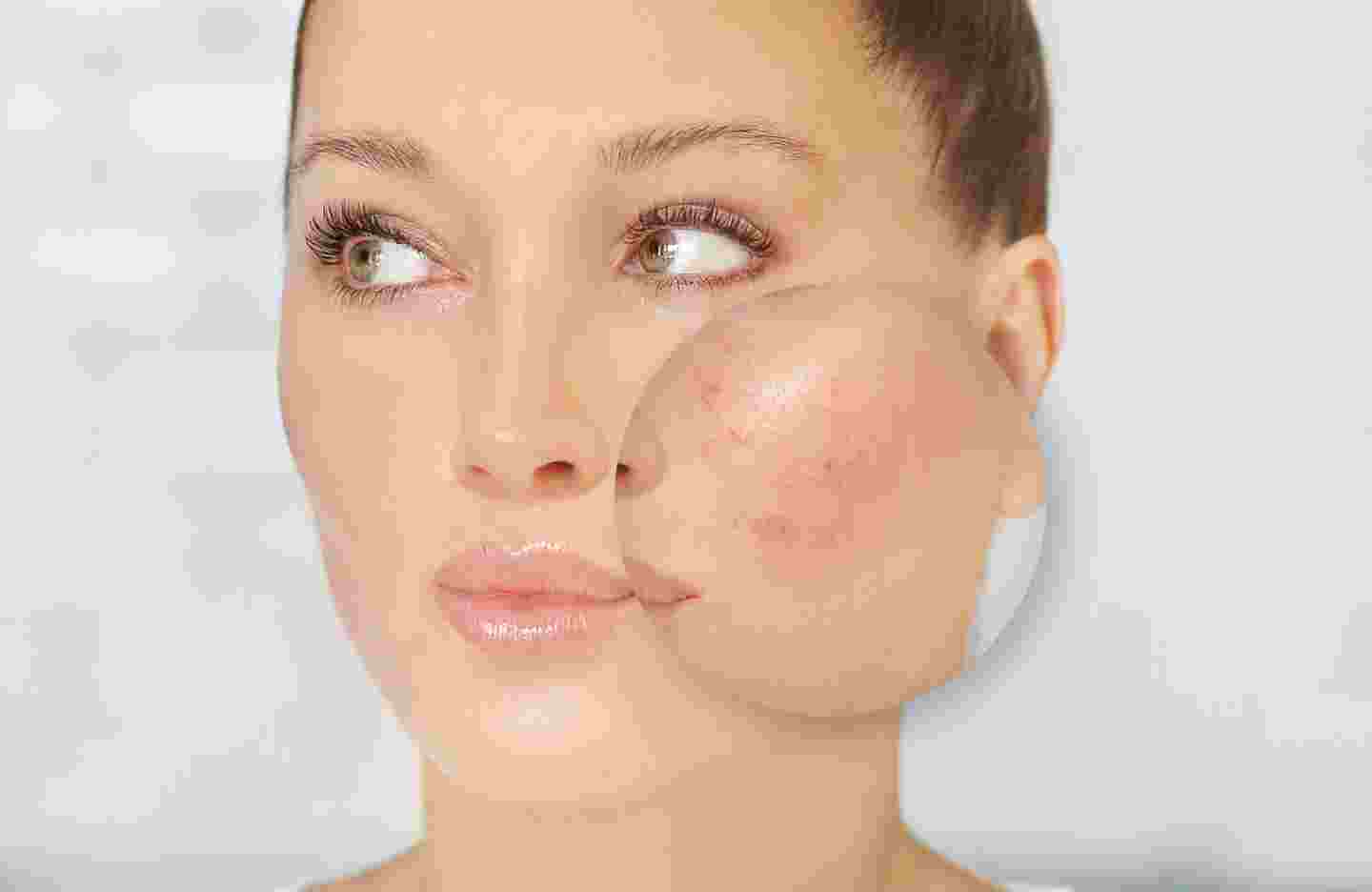 Rosacea@2x (1).jpg