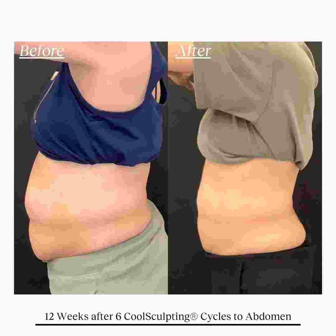 COOLSCULPTING  (6).jpg