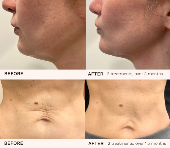 Laser Skin Tightening, Sydney Cosmetic Laser