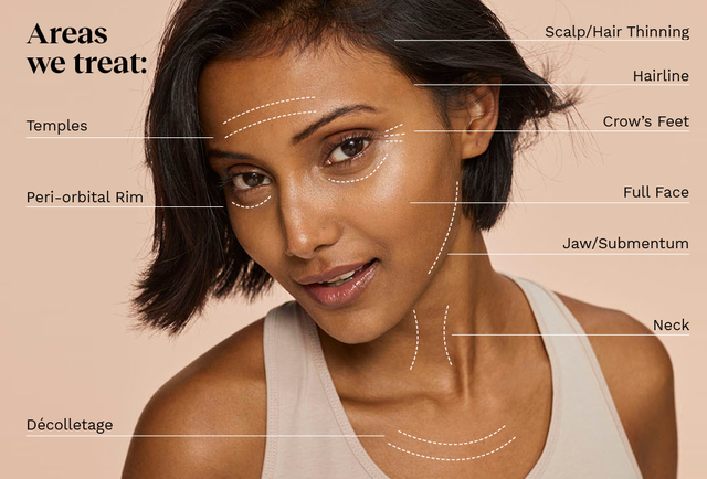 PRP Treatment Areas.png