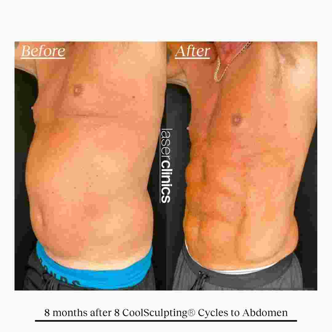 COOLSCULPTING  (8).jpg