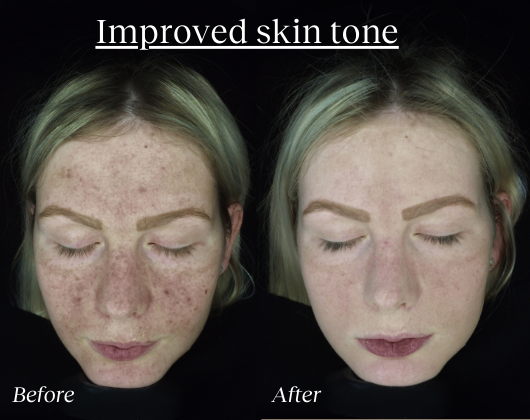 PRP Pigmentation B +A.png