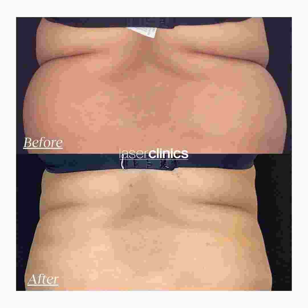 COOLSCULPTING  (3).jpg