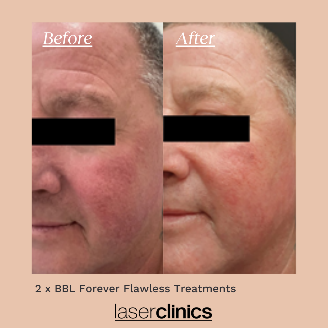 BBL B&A (16).png