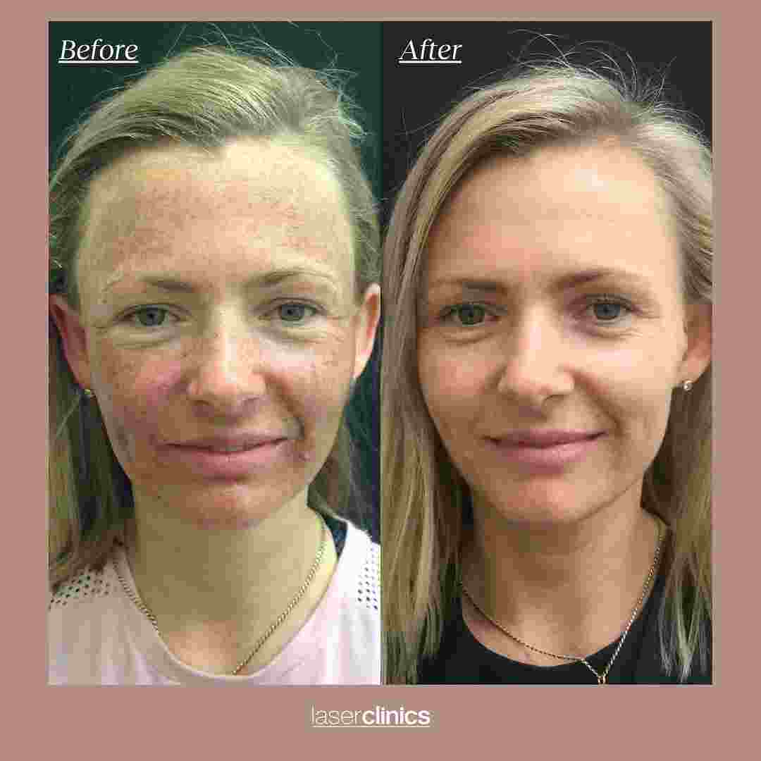skin8kleresca.jpg