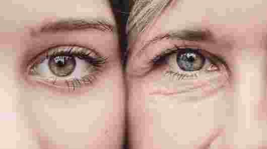 Addressing dark eye circles with fillers