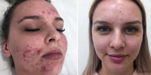 Acne shop treatment australia