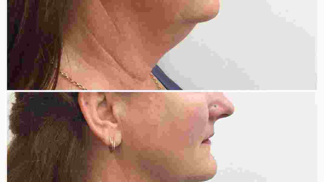 Chin Sculpting: Before & After