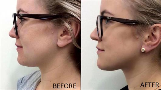 How To Get Rid Of Chubby Cheeks – Jawflex®