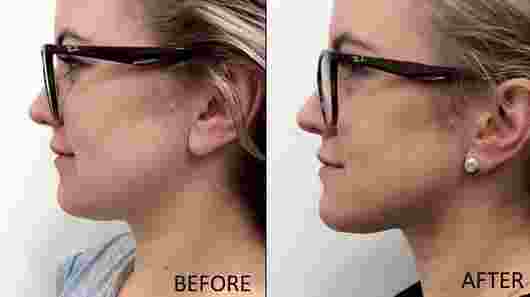 Double chin: the causes and how to get rid of it