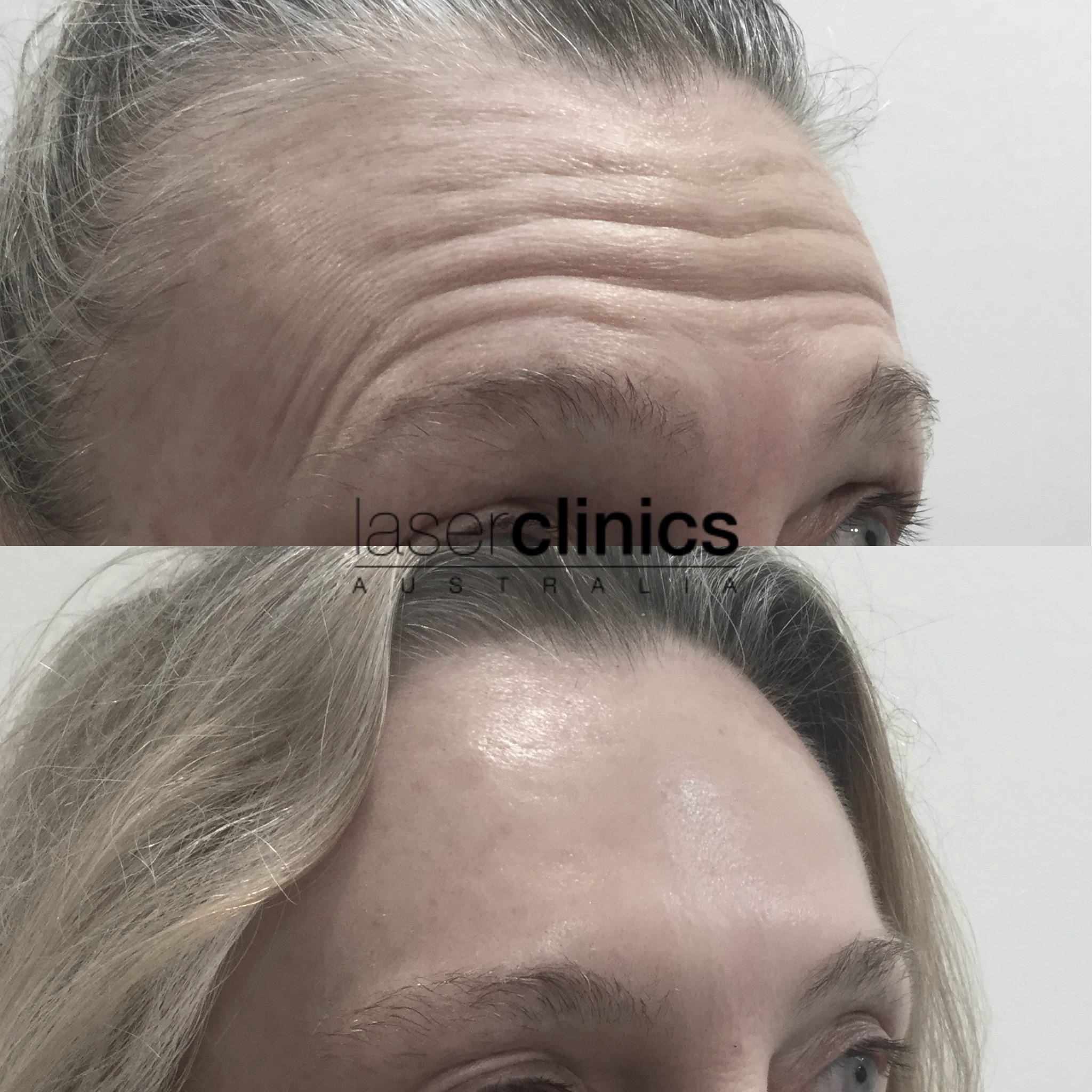 How Anti Wrinkle Injections Work Laser Clinics Australia