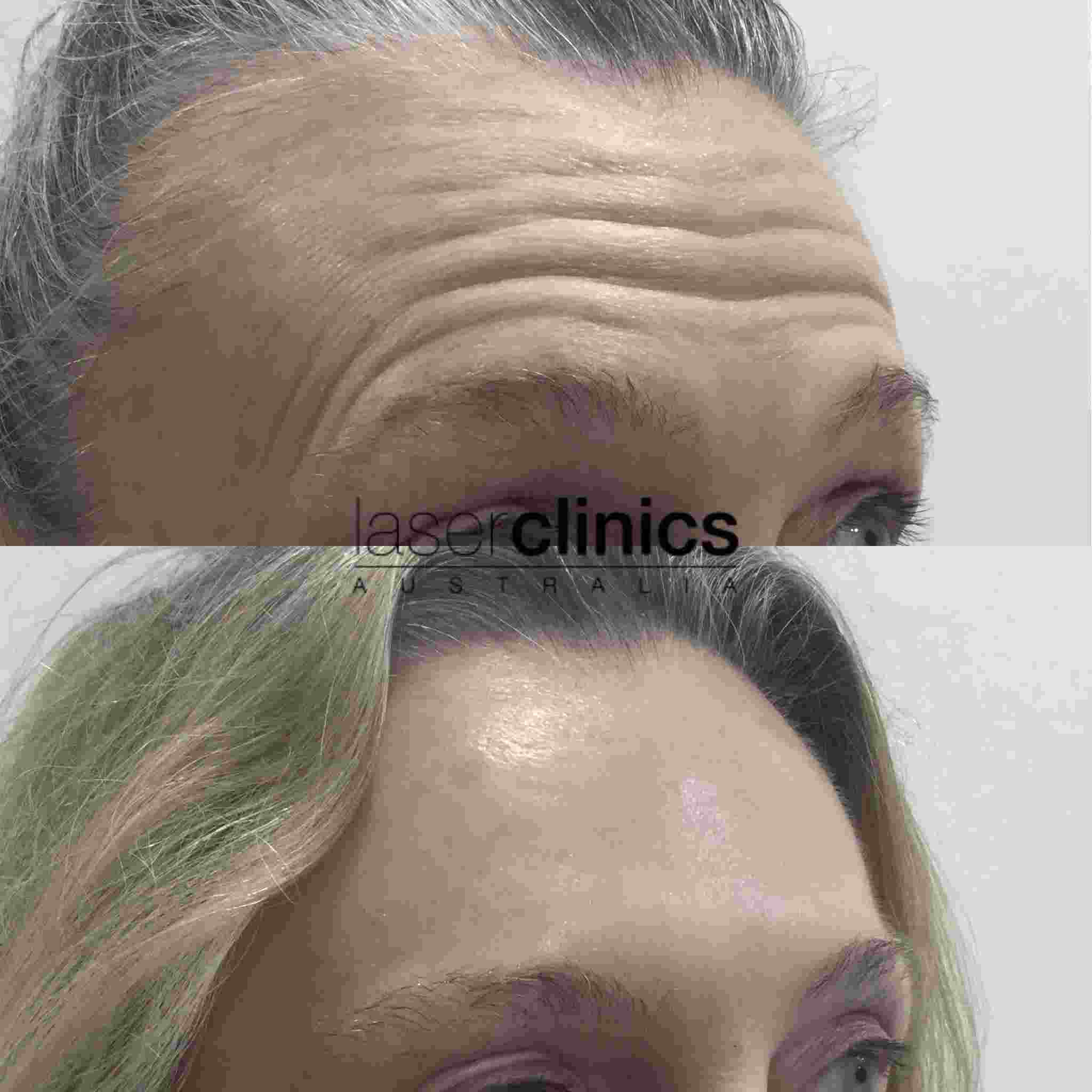 anti-wrinkle before and after.jpeg