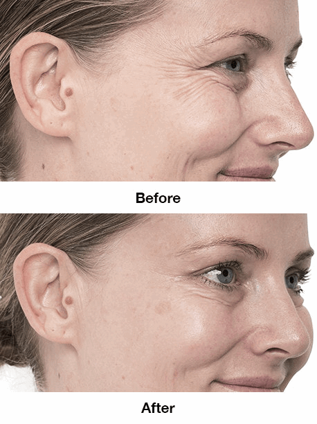 Crows feet wrinkles - Before and After