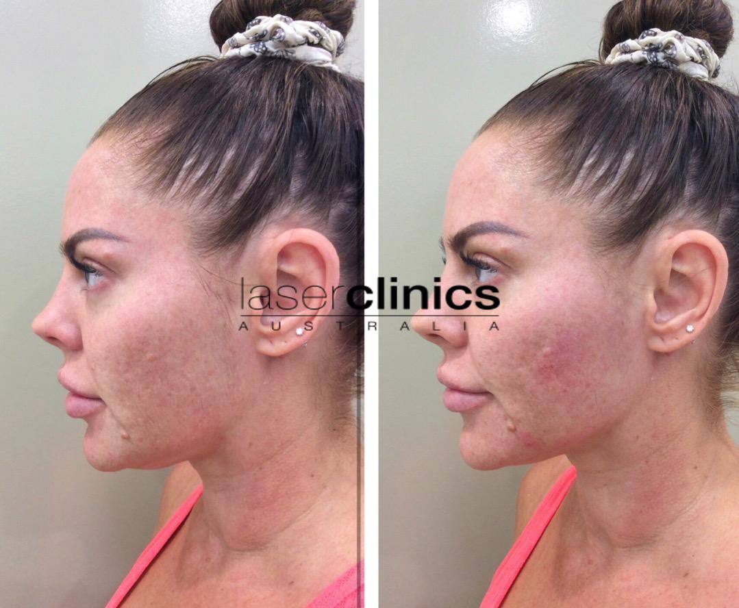 Toowong | Laser Clinics Australia Toowong | Laser Clinics Australia